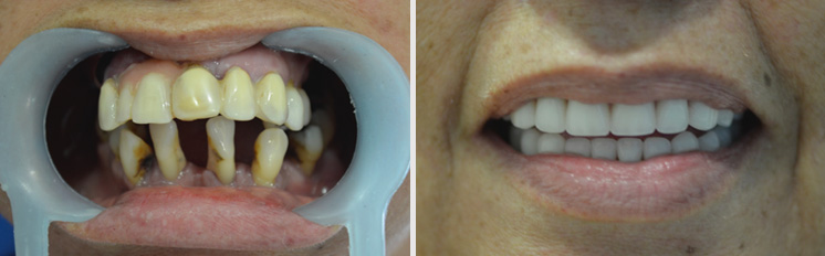 all on 4 dental implants