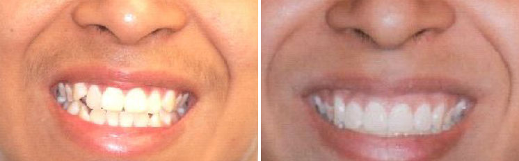 affrodable porcelain crowns