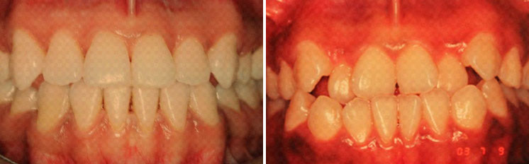 affrodable porcelain crowns
