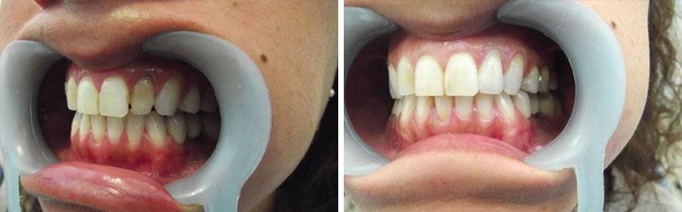 affrodable porcelain crowns